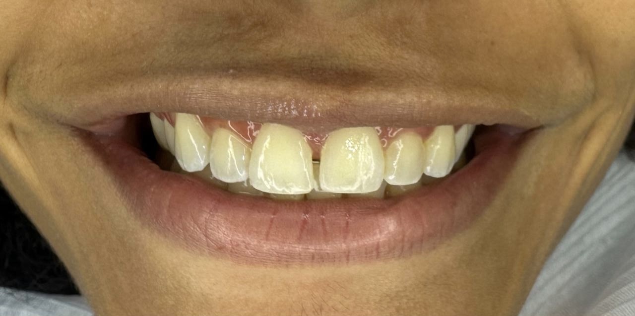 Antes do fechamento de diastema