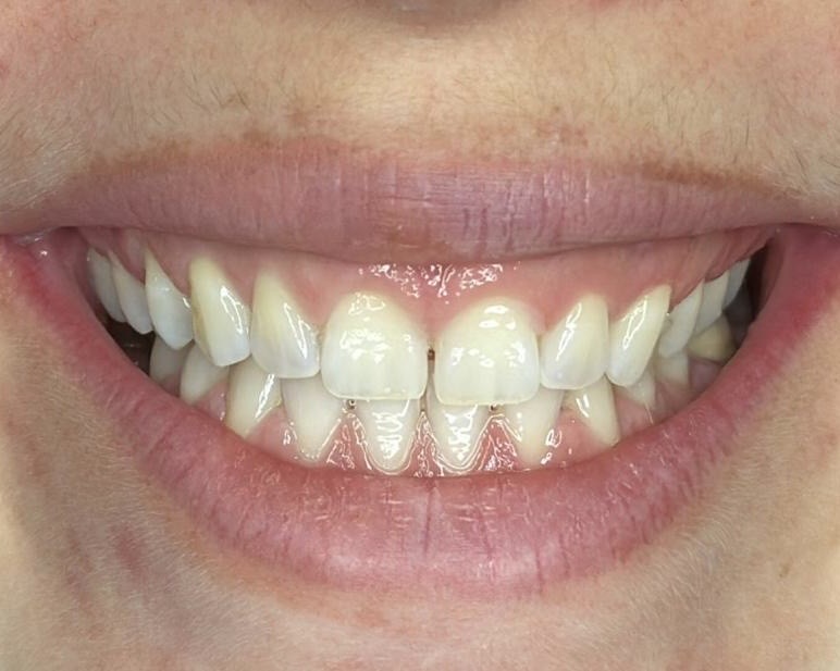 Antes da gengivoplastia