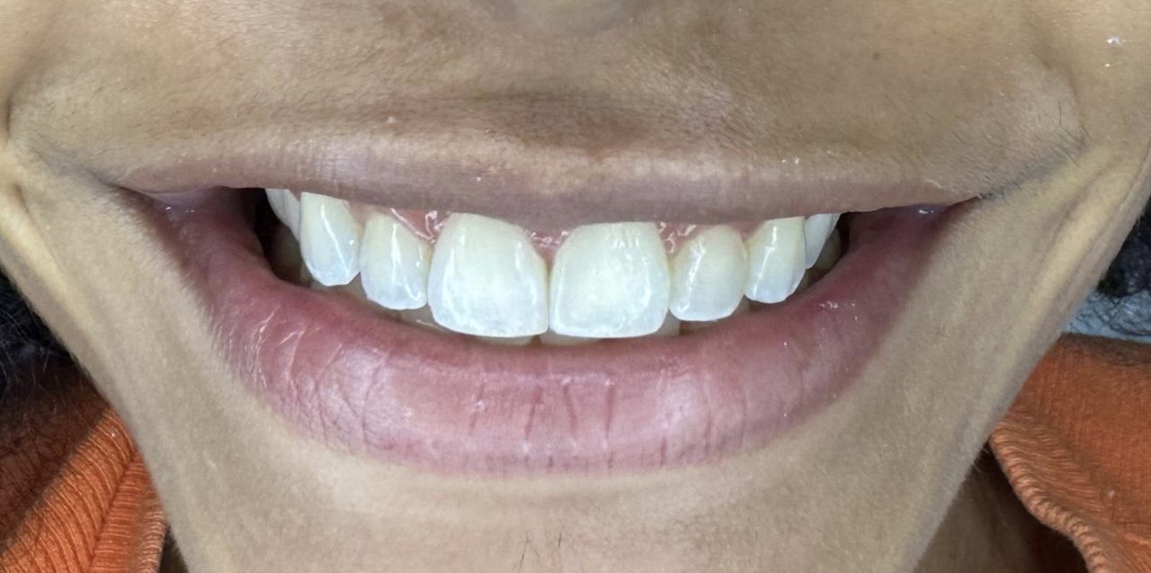 Depois do fechamento de diastema