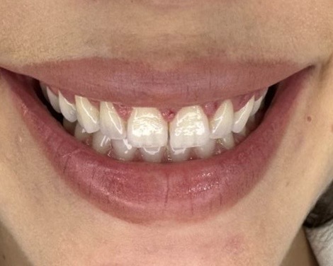 Depois da gengivoplastia